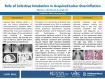 Role Of Selective Intubation To Inform Decision Making For Surgical Treatment Of Acquired Lobar Overinflation (ALO) In The Setting Of Pulmonary Hypertension (PH): A Case Report by Lilah Melzer, Brian Birnbaum, and Alvin Singh